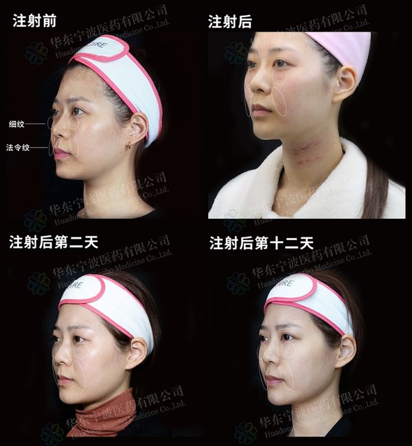 伊婉推出全新去細紋解決方案--伊婉蝴蝶術