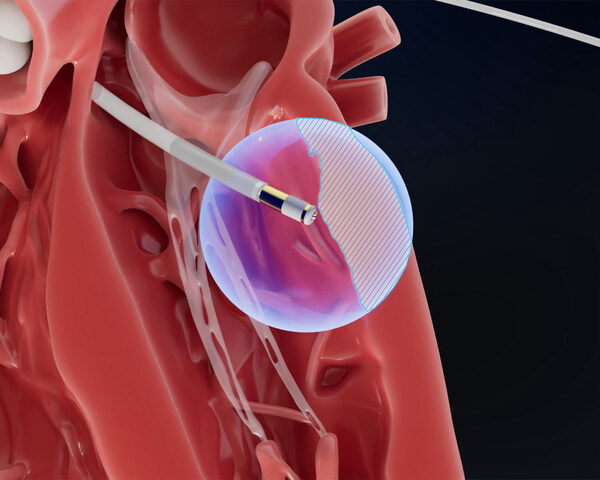 Field Medical: Engineered to reach the epicardium from the endocardium, the FieldForce? Ablation System catheter is designed to enable focal pulsed field ablation for full-thickness, transmural lesions.
